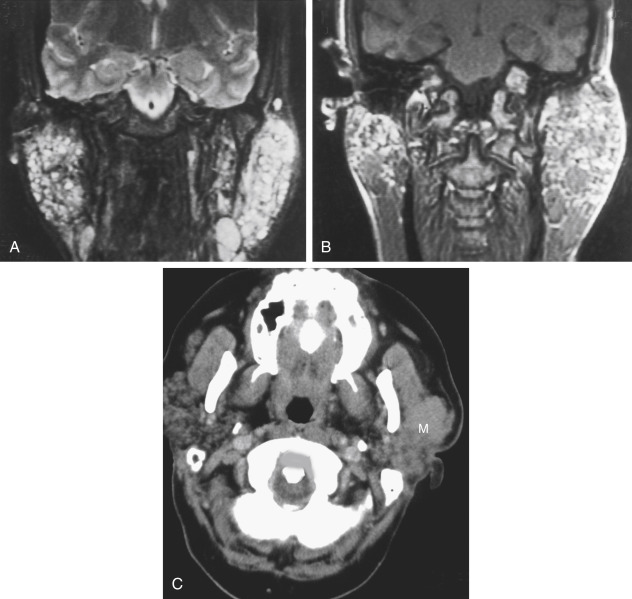 FIGURE 14-8, Sjögren syndrome. A, The coronal T2-weighted imaging (T2WI) reveals many tiny benign lymphoepithelial lesions (BLELs) as well as nodes inferiorly and bilaterally. B, Dominant masses are seen on the T1WI, but which do you biopsy? Fine-needle aspiration revealed lymphoid aggregates. C, Lymphoma of the parotid gland and Sjögren syndrome in another patient with rheumatoid arthritis. The axial computed tomography scan shows a mass (M) in the left parotid gland diffusely infiltrating its superficial and deep portion. The right gland is not normal, with mixed pattern of glandular density and fatty replacement. Note widening of the anterior atlantodental interval due to ligamentous laxity from the patient’s rheumatoid arthritis.