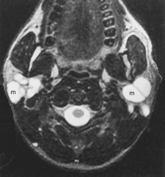 FIGURE 14-9, Lymphoepithelial lesions associated with human immunodeficiency virus (HIV). Parotid glands have multiple high intensity masses (m) on this fat-suppressed fast spin echo T2-weighted imaging, typical of lymphoepithelial cysts in this HIV-positive man.