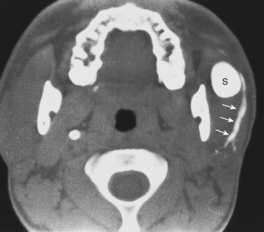 FIGURE 14-10, Sialocele. Axial computed tomography after left parotid sialography demonstrates opacification of a sialocele (s). One can see the normal parotid duct (arrows) coursing to and communicating with the sialocele on the left side. This patient had been punched in the left side of the face.