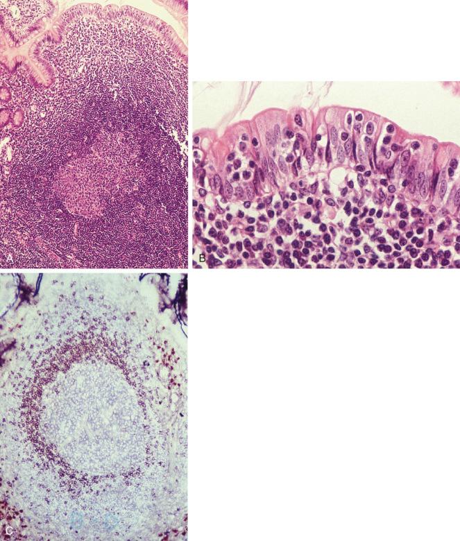 Figure 19-1, Morphologic and immunophenotypic features of Peyer's patch mucosa-associated lymphoid tissue (MALT).