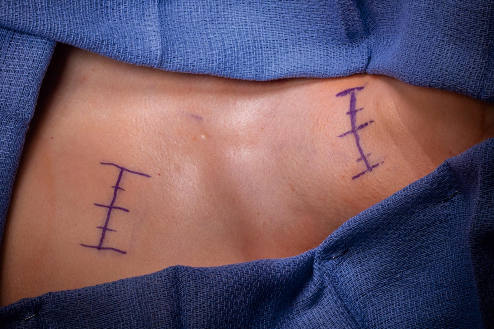 FIGURE 104.1, Cervical and subclavicular incisions. The midline is marked, as is the medial border of the sternocleidomastoid.