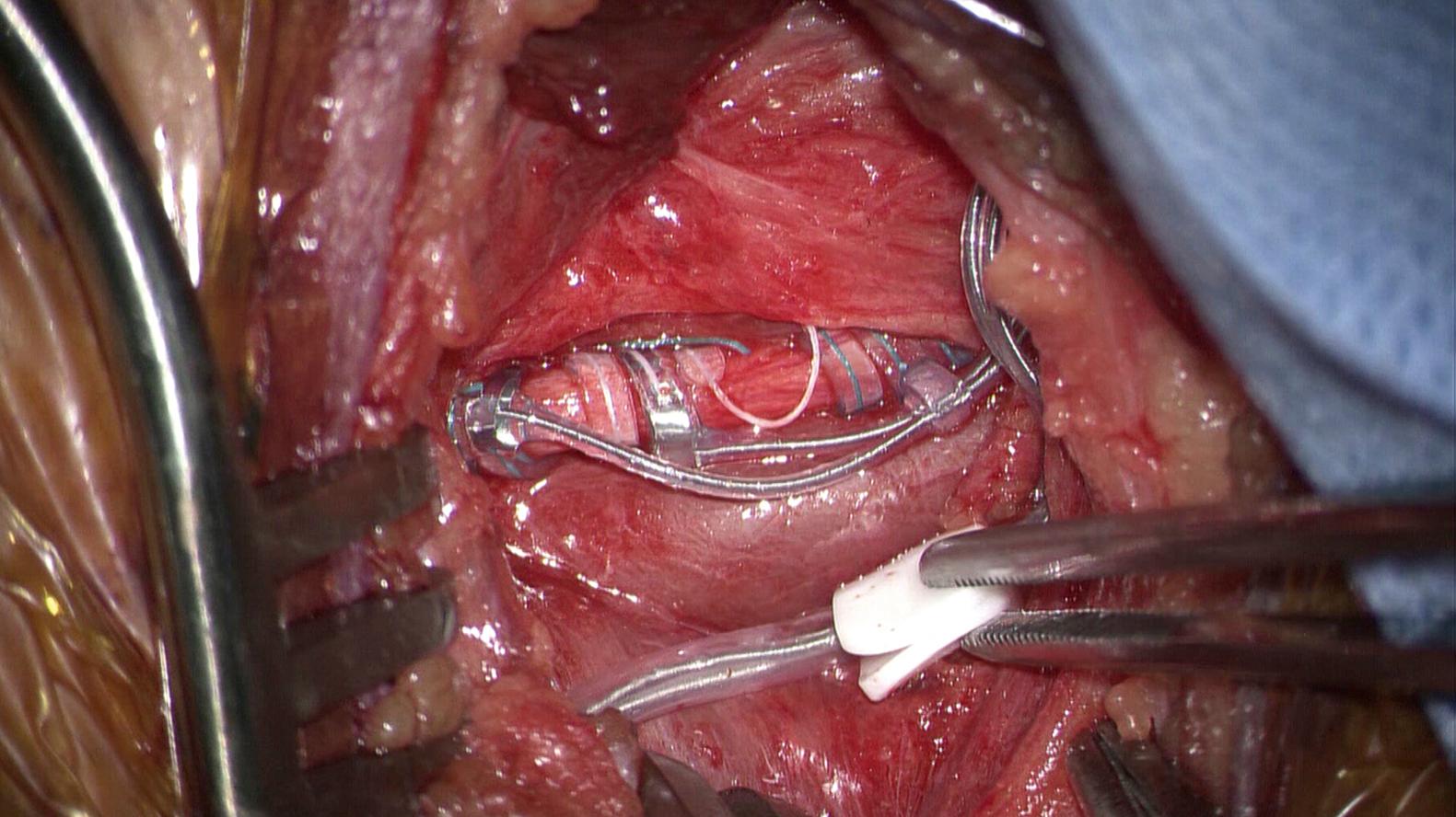 FIGURE 104.3, Final placement of the vagal nerve stimulation lead on the vagus nerve within the carotid sheath. The carotid artery has been retracted superiorly and the internal jugular vein has been retracted inferiorly.