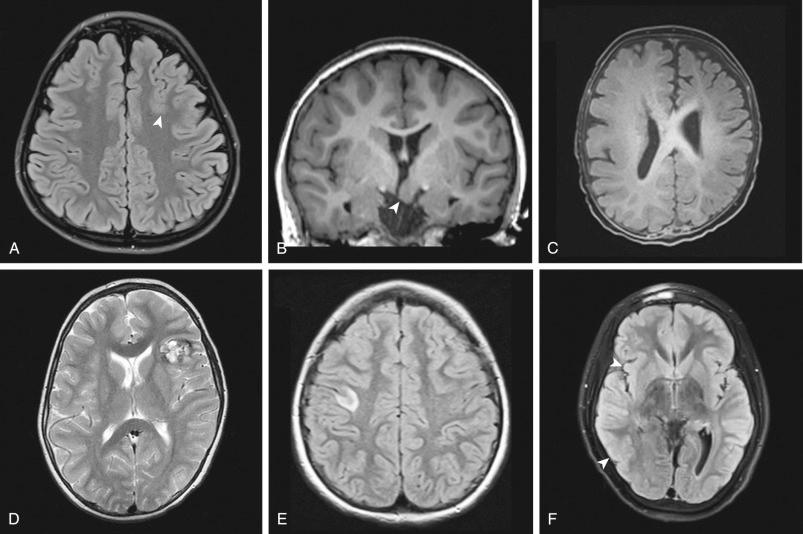 Figure 56.1, Different etiologies causing extratemporal epilepsy. (A) Cortical dysplasia (arrowhead) . (B) Hypothalamic hamartoma (arrowhead) . (C) Hemimegalencephaly. (D) Cavernous malformation. (E) Ganglioglioma. (F) Rasmussen encephalitis (arrowheads mean increased signal regions) .