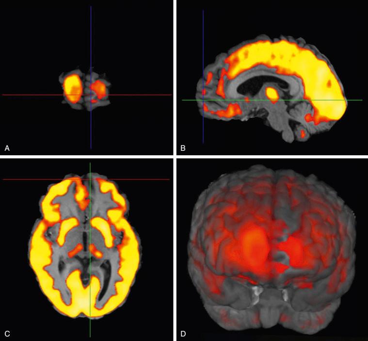 Figure 56.3, Examples of left frontal hypometabolism seen on [ 18 F]-fluorodeoxyglucose (FDG) positron emission tomography (PET) scanning. (A) Frontal view. (B) Left midsagittal view. (C) Axial view. (D) Three-dimensional reconstruction.