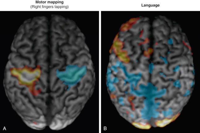Figure 56.4, (A) Left motor activation while right finger tapping and (B) left hemispheric language dominance documented by word generation during functional magnetic resonance imaging (fMRI).