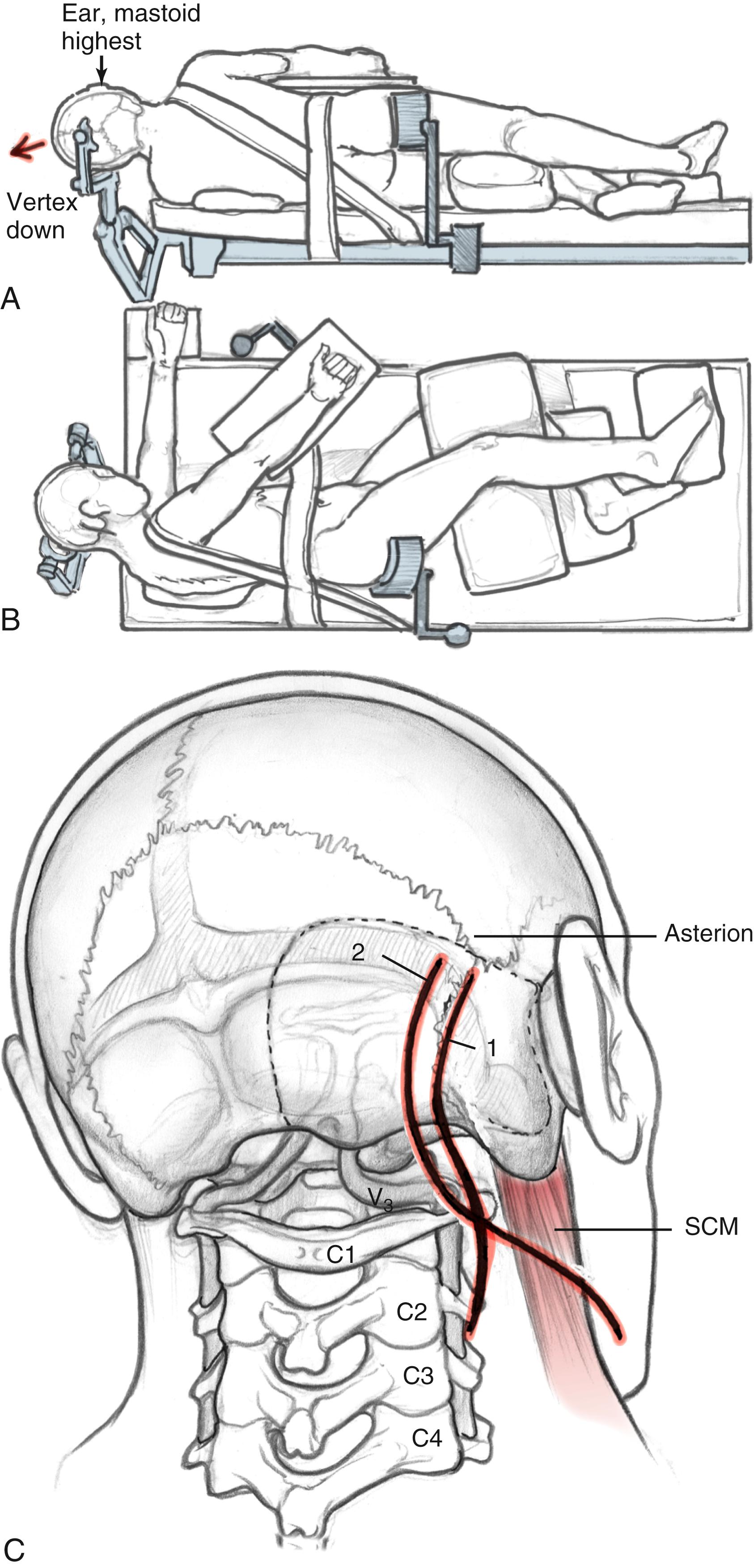 Fig. 54.2, (A and B) Patient positioning for dorsolateral extreme lateral infrajugular transcondylar procedure, lateral decubitus position. (C) Incisions. 1, Lazy S incision for dorsolateral approach; 2, Question mark–shaped incision for anterolateral approach. SCM, Sternocleidomastoid muscle.