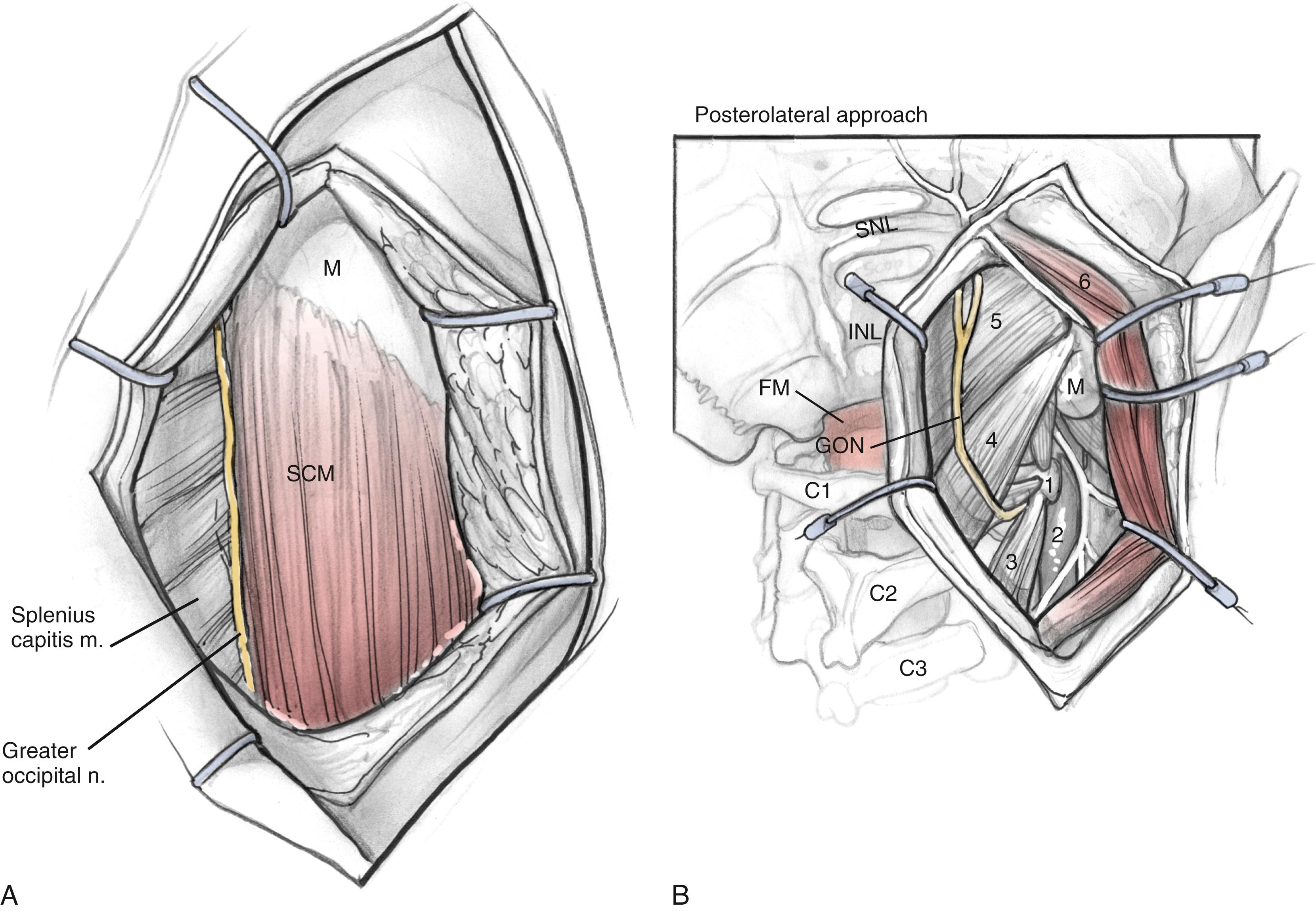 Fig. 54.3, (A) Superficial dissection. (B) Middle layer. 1, C1 transverse process; 2, internal jugular vein; 3, levator scapula muscle; 4, longissimus muscle; 5, splenius capitis muscle; 6, sternocleidomastoid muscle. FM, Foramen magnum; GON, greater occipital nerve; IJV, internal jugular vein; INL, inferior nuchal line; M, mastoid process; SCM, sternocleidomastoid muscle; SNL, superior nuchal line.