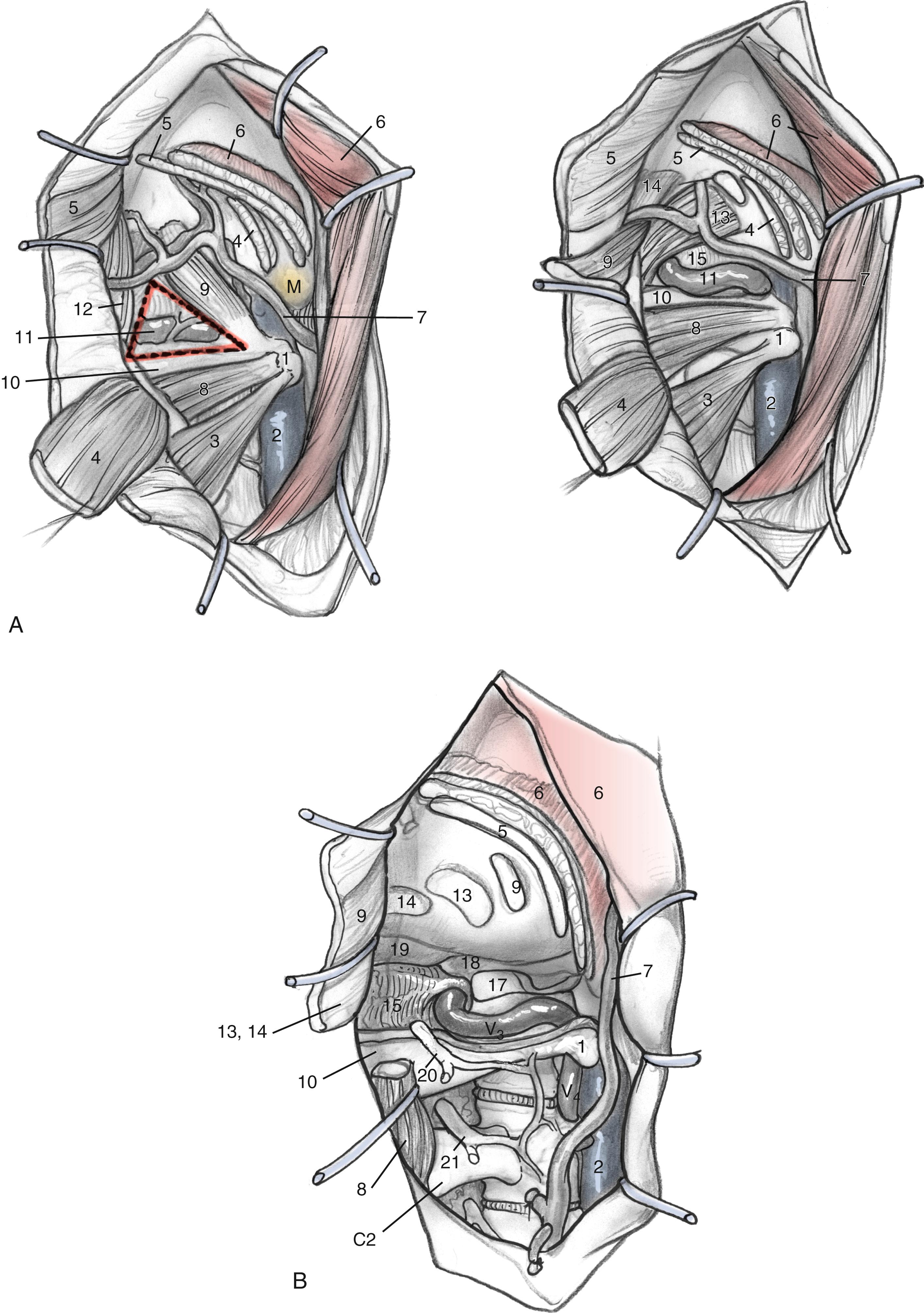 Fig. 54.4, (A) Deep muscle layer, including suboccipital triangle. (B) Dissection deep to muscle. 1, C1 transverse process; 2, internal jugular vein; 3, levator scapulae muscle; 4, longissimus muscle; 5, splenius capitis muscle; 6, sternocleidomastoid muscle; 7, great occipital nerve; 8, inferior oblique nerve; 9, superior oblique muscle; 10, C1 lamina; 11, V 3 and C1 nerve root in suboccipital triangle; 12, semispinalis muscle; 13, rectus capitis major muscle; 14, rectus capitis minor muscle; 15, posterior atlanto-occipital membrane; 16, C1 condyle; 17, occipital condyle; 18, condylar fossa; 19, foramen magnum; 20, C1 root; 21, C2 root. IJV, Internal jugular vein; M, mastoid process; SCM, sternocleidomastoid muscle.