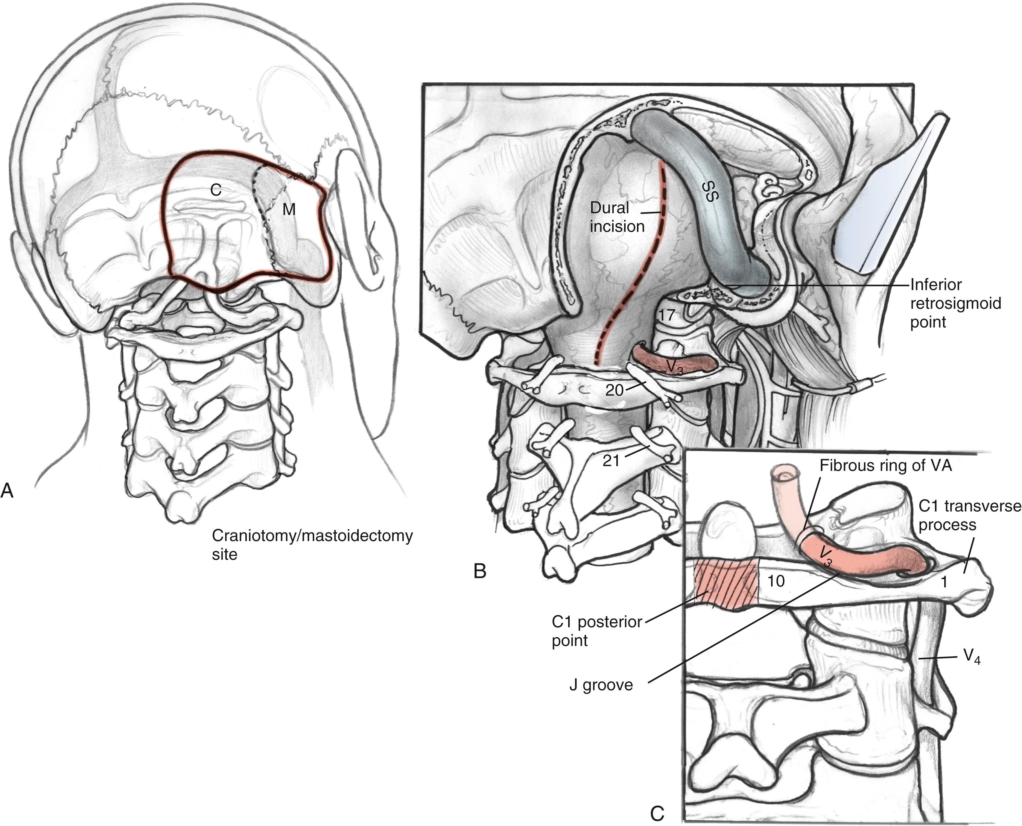 Fig. 54.5, (A–C) Identification of the V 3 segment of the vertebral artery, including the use of the J groove in dissection. 1, C1 transverse process; 10, C1 lamina; 17, occipital condyle; 20, C1 root; 21, C2 root. M, Mastoid process; SS, sigmoid sinus; VA, vertebral artery.