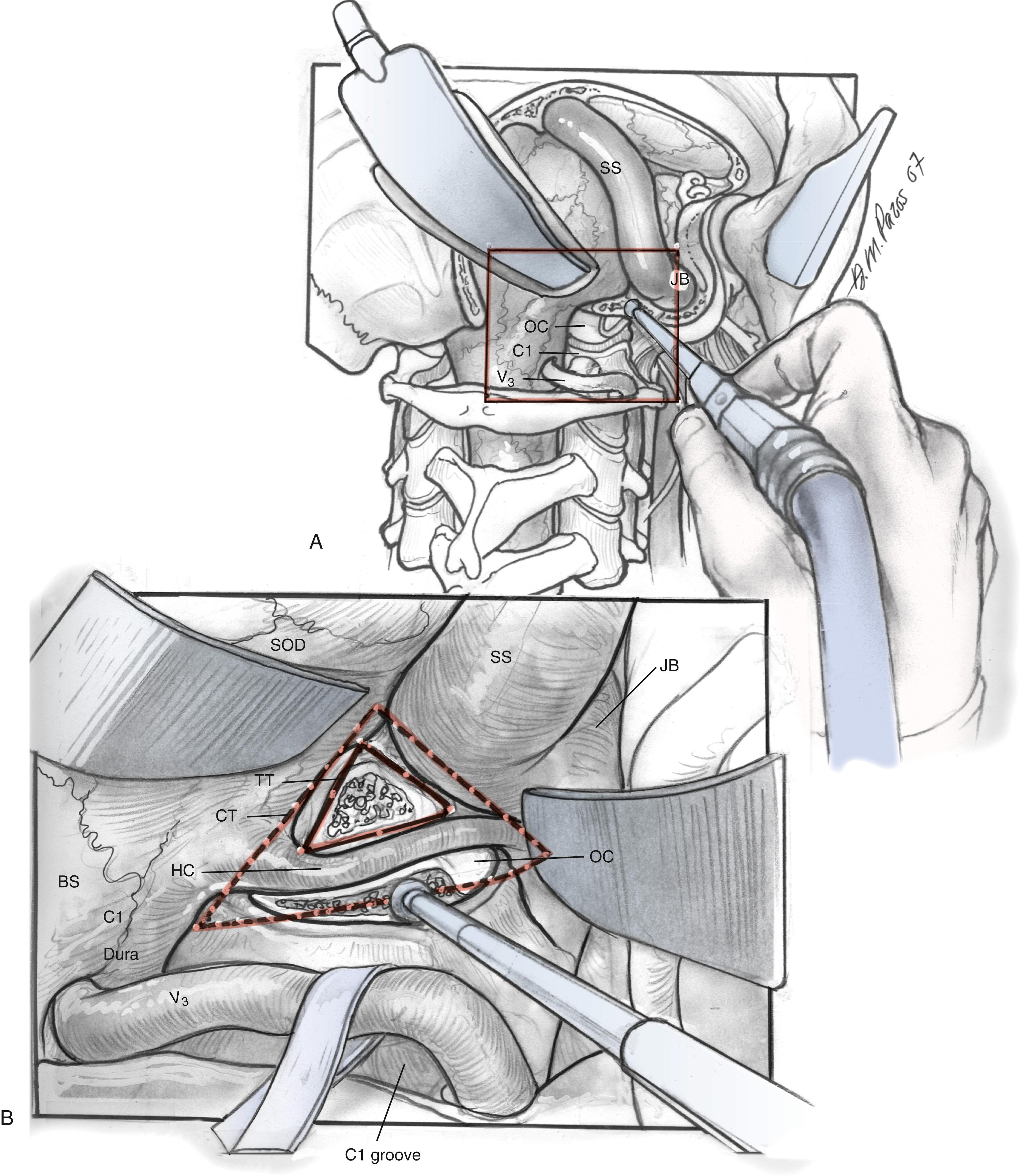 Fig. 54.6, (A and B) Dissection of occipital condyle.(C–E) Further dissection toward the foramen magnum and clivus, with exposure of the ventral medullary area. A to B, jugular tubercle JT length = 1.2–3.0 (1.65) cm; C to D, JT height = 0.7–1.7 (1.05) cm; E to F, JT thickness = 0.2–1.0 (0.61) cm. BA, Basilar artery; BS, brainstem; CC, common carotid artery; Cl, condyle atlas; CT, condylar triangle; HC, hypoglossal canal and CN XII; JB, jugular bulb; JF, jugular foramen; JT, jugular tubercle; JV, jugular vein; OC, occipital condyle; MFD, middle fossa dura; PFD, posterior fossa dura; SOD, suboccipital dura; SS, sigmoid sinus; TT, tubercular triangle; VA, vertebral artery.