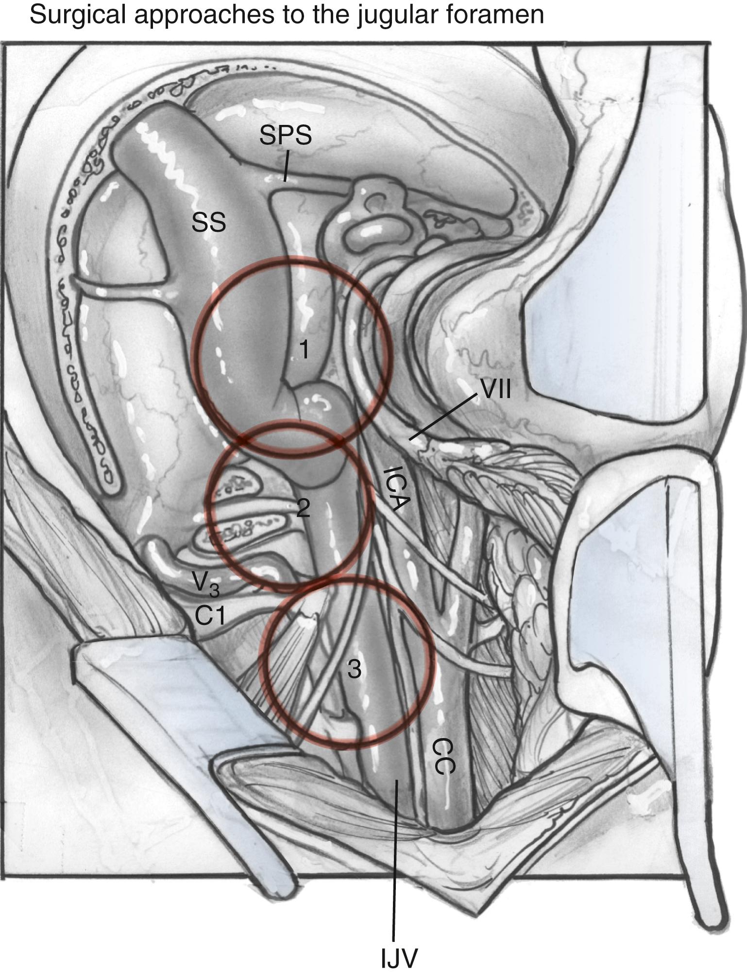 Fig. 54.7, Exposure afforded by various approaches. 1, Suprajugular, retrofacial, infralabyrinthine approach; 2, infrajugular transcondylar approach; 3, high cervical approach. CC, Common carotid artery; ICA, internal carotid artery; IJV, internal jugular vein; SPS, superior petrosal sinus; SS, sigmoid sinus.