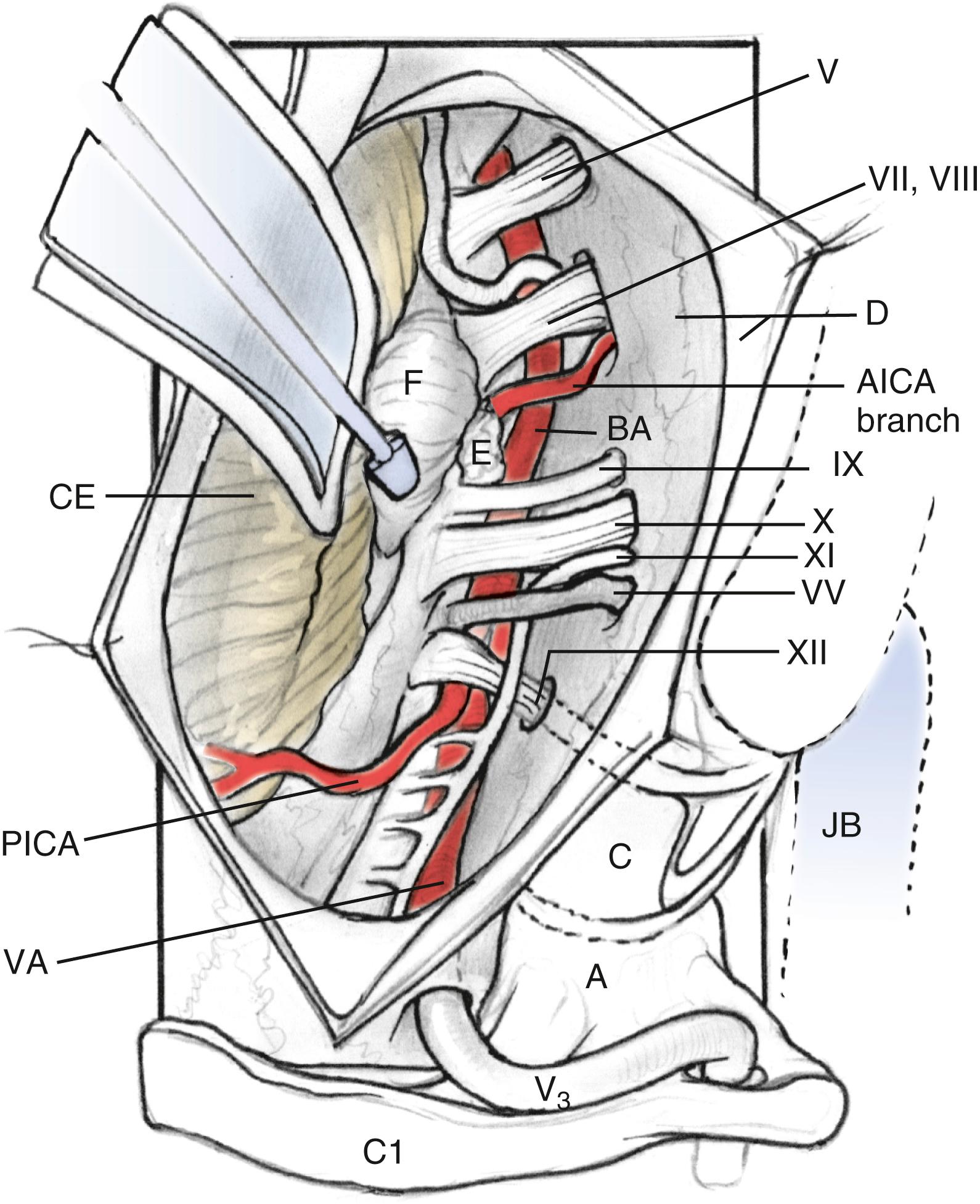 Fig. 54.8, Extreme lateral infrajugular transcondylar exposure, including high cervical dissection. A, Atlas C1 superior articular facet; B, brainstem; C, occipital condyle; D, dura; E, choroid plexus; F, flocculus. AICA, Anterior inferior cerebellar artery; BA, basilar artery; CE, cerebellum; JB, jugular bulb; PICA, posterior inferior cerebellar artery; VA, vertebral artery; VV, vagal vein.