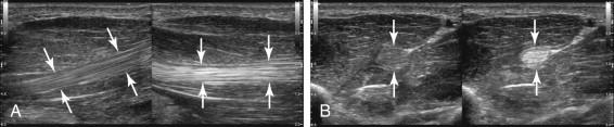 F igure 11-1, Normal tendon. A, Longitudinal view of the flexor pollicis longus (arrows) shown at 90 degrees to the direction of the sound pulses (right side) and at less than 90 degrees (left side). Note the easily identifiable hyperechoic, fibrillar echotexture seen on the right image but not on the left. B, Transverse view of the flexor pollicis longus showing similar findings.