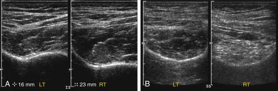 F igure 11-17, Muscle atrophy in different patients with rotator cuff tears. A, Dual views of the left (LT) and right (RT) infraspinatus muscles show symmetric echogenicity of the muscles, but decreased thickness of the left compared with the right (16 mm vs. 23 mm) indicating atrophy. B, Dual views of the left and right supraspinatus muscles show increased echogenicity and decreased thickness of the right muscle indicating atrophy and fatty infiltration.
