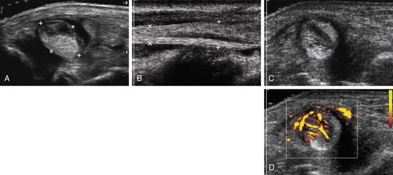 F igure 11-3, Partial-thickness tendon tear in different patients. A, Transverse view of the posterior tibial tendon (cursors) shows a distinct hypoechoic defect in the superficial aspect of the tendon consistent with a partial tear. B, Longitudinal view of the posterior tibial tendon (cursors) in another patient shows a distinct, linear, hypoechoic, longitudinally oriented partial tear in the central aspect of the tendon. Transverse gray-scale (C) and power Doppler (D) views of the posterior tibial tendon (cursors) show a central hypoechoic defect with increased vascularity.