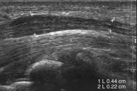 F igure 11-26, Carpal tunnel syndrome. Longitudinal view of the median nerve at the wrist level shows swelling of the nerve (0.44 mm vs. 0.22 mm) just proximal to the carpal tunnel.