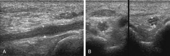 e -F igure 11-8, Ulnar nerve injury. A, Longitudinal view of the ulnar nerve at the level of the elbow shows focal swelling (cursors) . B, Transverse dual images of the right (cursor 1) and left (cursor 2) ulnar nerves show swelling and loss of the fascicular architecture on the right. This occurred after prolonged pressure on the nerve due to arm placement during cardiac surgery.