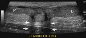 e -F igure 11-2, Full-thickness tear of the Achilles tendon. Longitudinal view shows a defect between the proximal (P) and distal (D) Achilles tendon. Refractive shadowing (arrows) is seen in the region of the torn tendon ends. Longitudinal video (see Video 11-3 ) taken while the patient flexes and extends the foot shows the change in separation of the torn tendon ends and confirms the size and location of the tear.