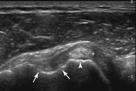 F igure 11-6, Tendon dislocation. Transverse view of the anterior humeral head shows the proximal biceps tendon (cursors) overlying the lesser tuberosity (arrowhead) and an empty tendon groove (arrows) .