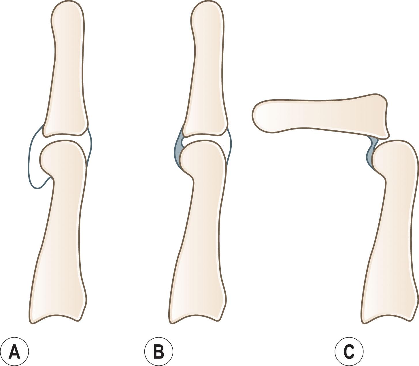 Figure 19.2, (A) The anterior capsule allows the base of the proximal phalanx to glide over the head of the metacarpal. (B) During contracture release, the adhesions over the head of the metacarpal have to be released, otherwise the base will dislocate on attempting to correct the deformity (C) .