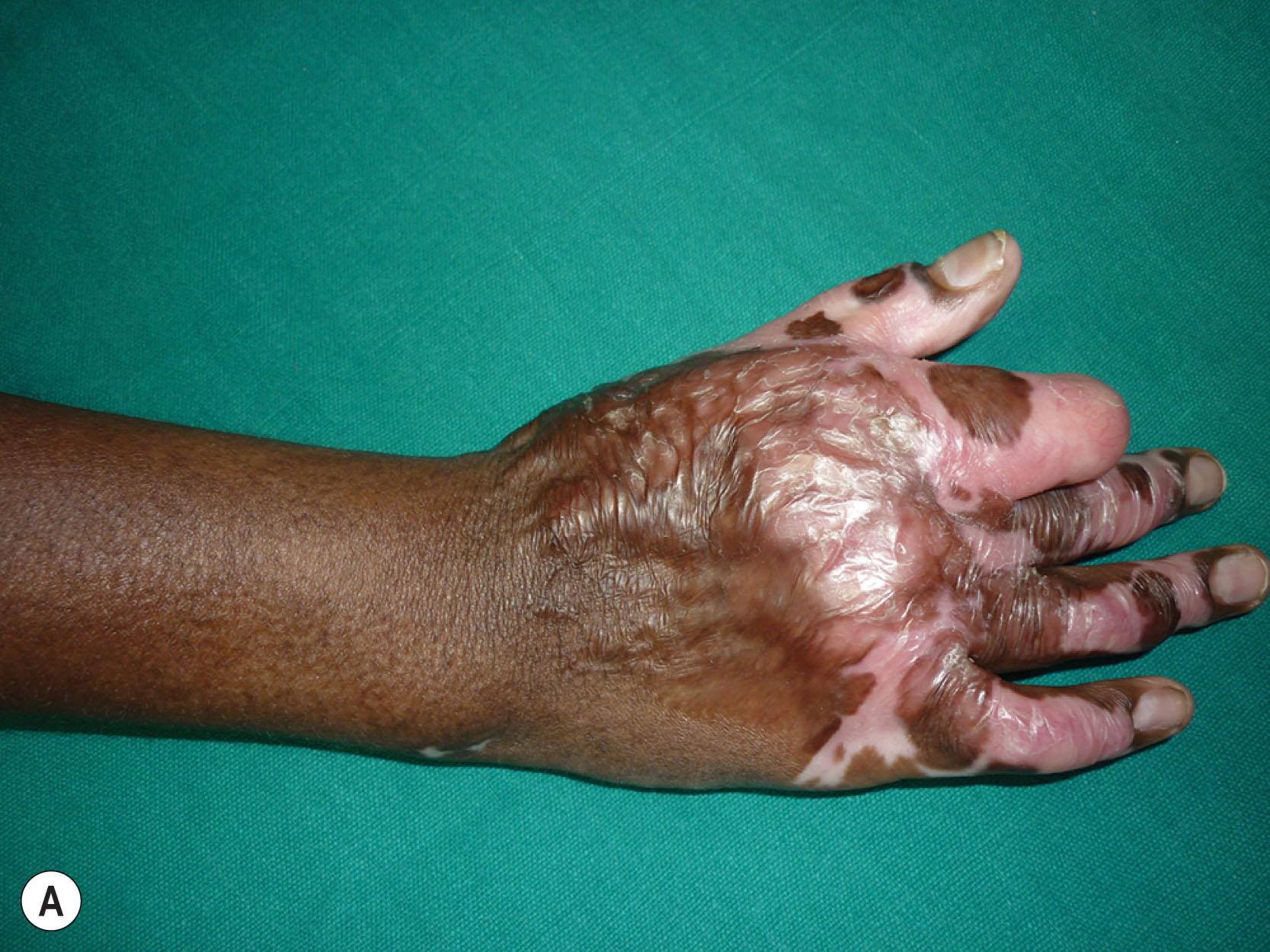 Figure 19.3, (A–C) Pictures showing dorsal contracture of the hand, with contracted first web space and flexor contracture of the index finger. (D) First web release. Note the recommended position of full abduction, pronation of thumb, and stabilization in line with the radial aspect of index finger. (E) Position of the MCP joints after release. (F–H) Long-term result after groin flap cover to the raw area.