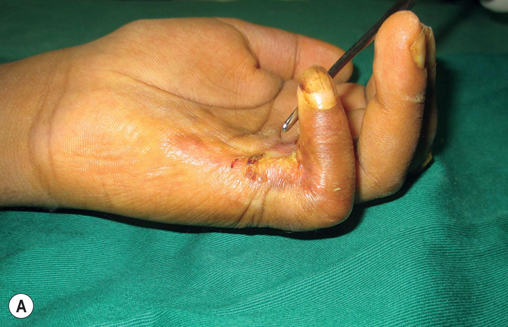 Figure 19.5, (A,B) Sixty-day-old low voltage electrical burns causing contracture of the little finger and exposure of the dorsum of the PIP joint with loss of central slip. (C) Little finger contracture release exposing the flexors and neurovascular bundle. (D) Central slip reconstructed by turn-over extensor flap in the middle finger. The picture also shows the cross-finger flap raised over the dorsum of the ring finger. (E–G) Long-term postoperative result showing the functional and aesthetic outcome.