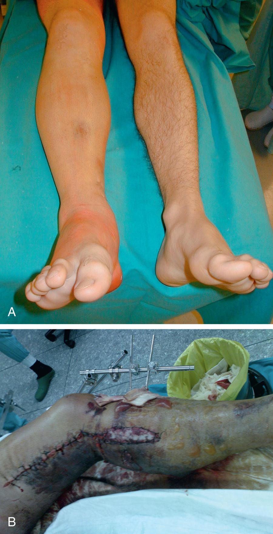 Fig. 151.1, A, A patient with right lower extremity compartment syndrome caused by isolated tibial fracture. On clinical presentation, pain, swelling, and inability of dorsal flexion of the toe were noted. B, Another patient with left lower extremity compartment syndrome after popliteal artery tear and revascularization in combination with proximal tibial fracture was treated with external fixation. A few hours later after initial treatment, there are obvious signs of developing compartment syndrome with swelling, skin discoloration, function loss, and fracture blisters.