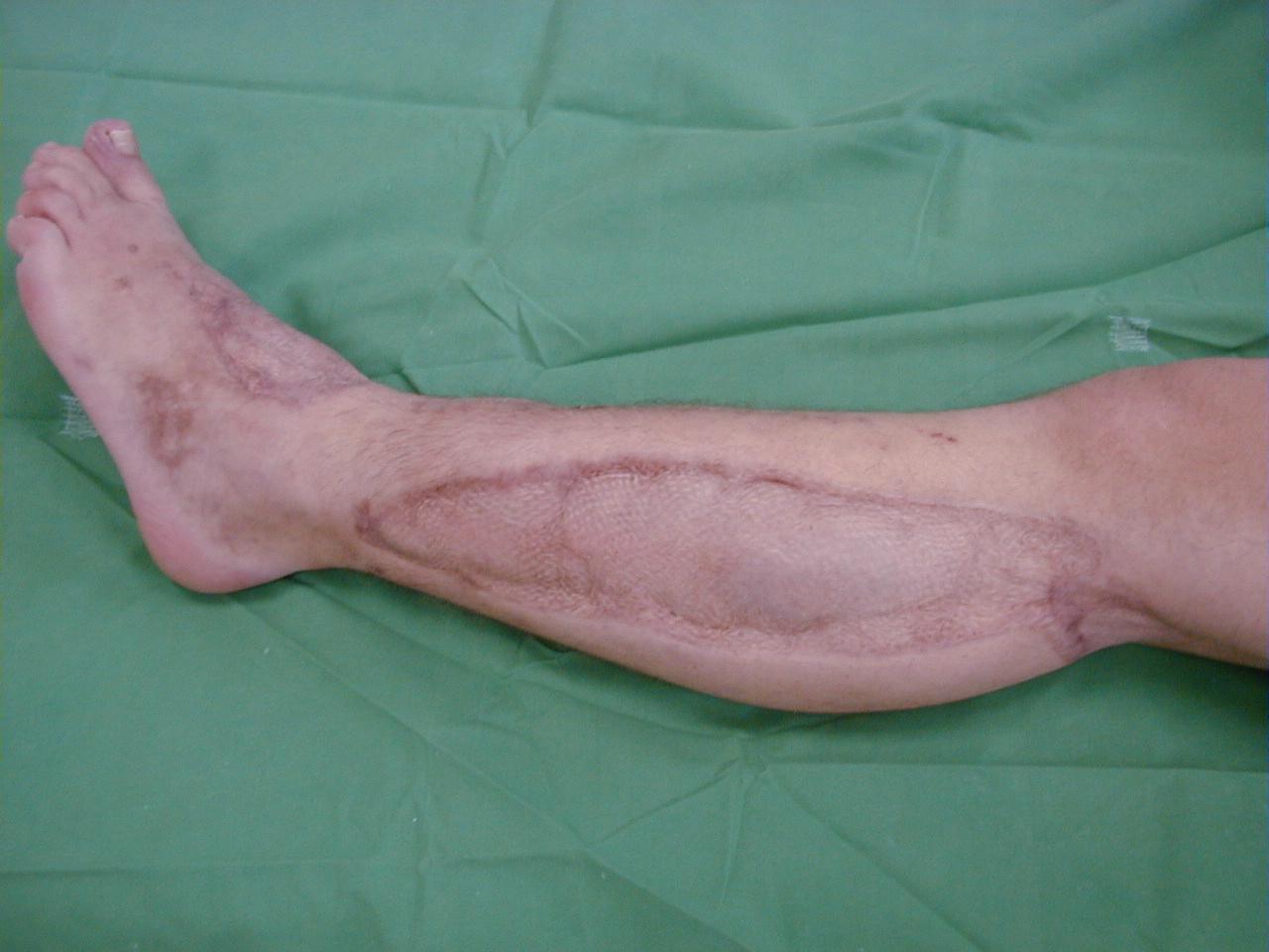 Fig. 151.4, Cosmetic result of the lower extremity compartment syndrome after mesh grafting of the lateral compartment.