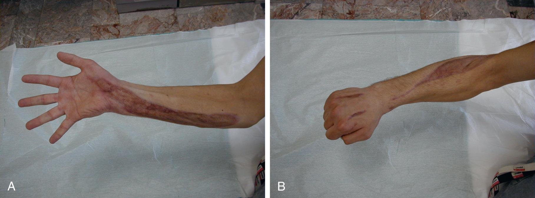 Fig. 151.6, Clinical photographs of combined fasciotomy of the upper extremity.