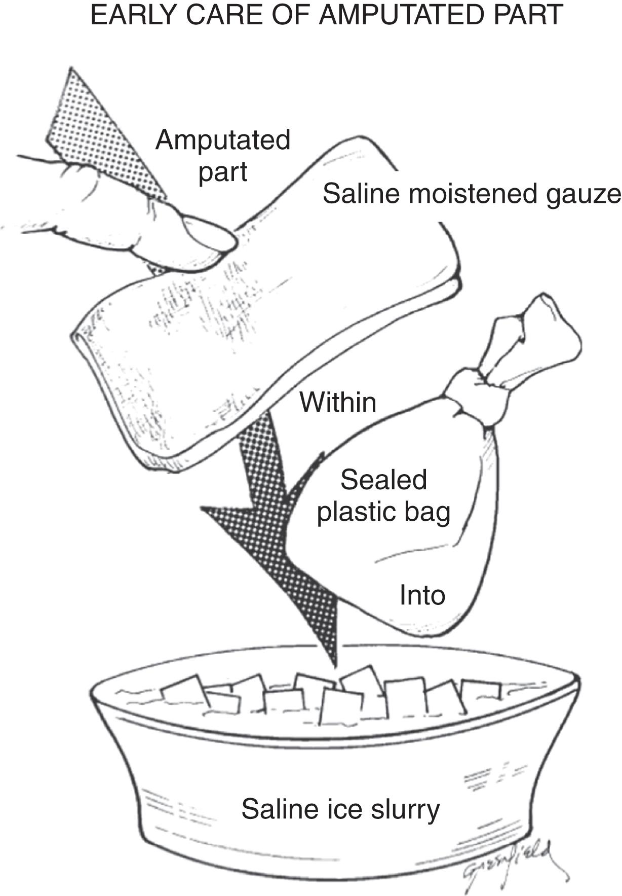 FIGURE 1, Management of the amputated part. The amputated part is wrapped in gauze, placed in a plastic bag, sealed, and set on ice.