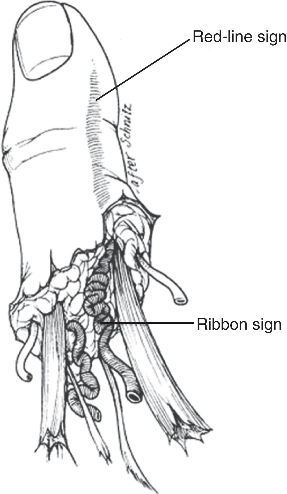 FIGURE 2, Assessment of amputated part. The red line and ribbon signs are poor prognostic signs for replantation.