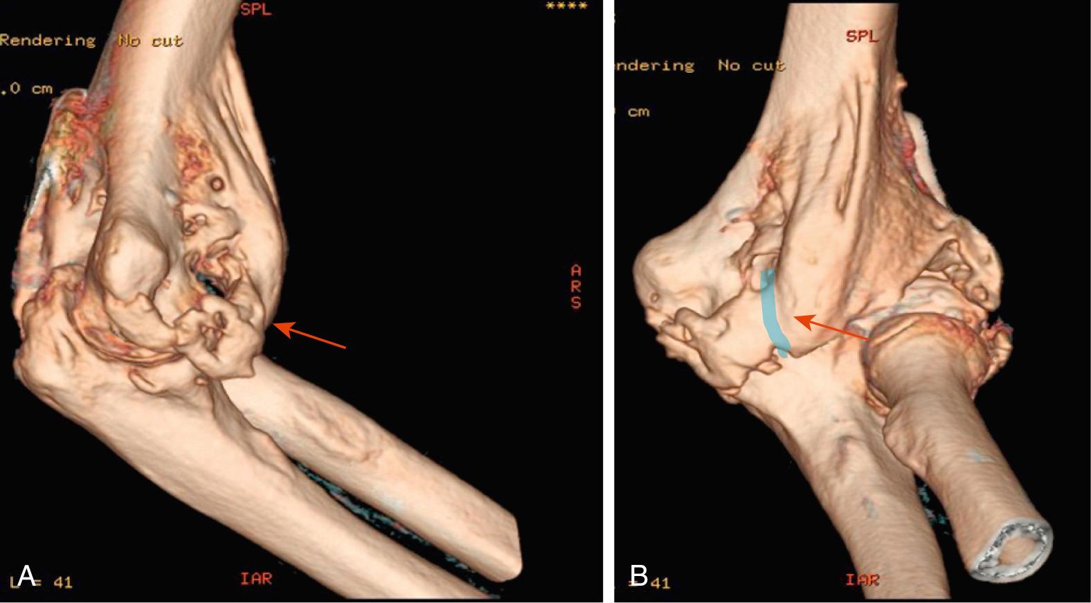 FIG 54.2, Computed tomography scan with three-dimensional reconstruction of a left elbow lateral (A) and anterior (B) views showing massive heterotopic ossification. The red arrow indicates the location of the median nerve (blue line) , which was nearly encased in the heterotopic ossification and highlights the importance of preoperative planning with this imaging scan when nerve involvement is anticipated.