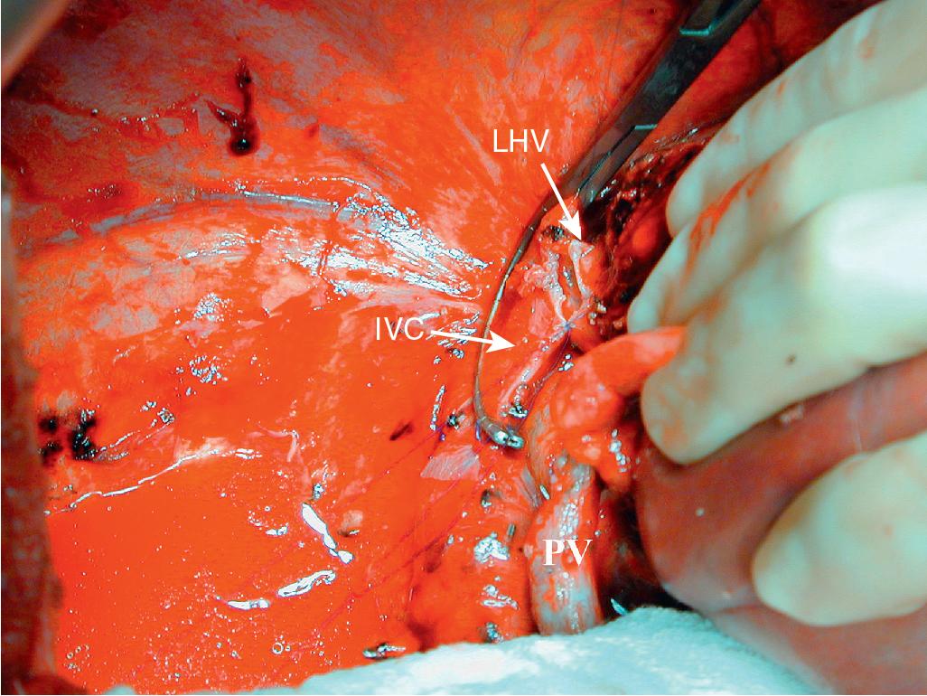 FIGURE 124.4, A vascular clamp can be placed tangentially on the inferior vena cava (IVC), occluding the implantation site of the hepatic vein but allowing maintenance of cava flow. This maneuver may allow in situ perfusion to be performed without the need for veno-venous bypass. LHV, Left hepatic vein; PV, portal vein.