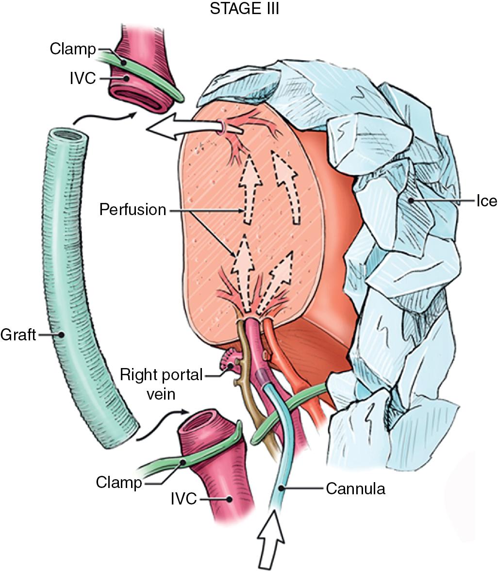 FIGURE 124.5, Continuous cold flushing of the remnant liver allows resection and reconstruction of the hepatic vasculature without time pressure. IVC, Inferior vena cava.