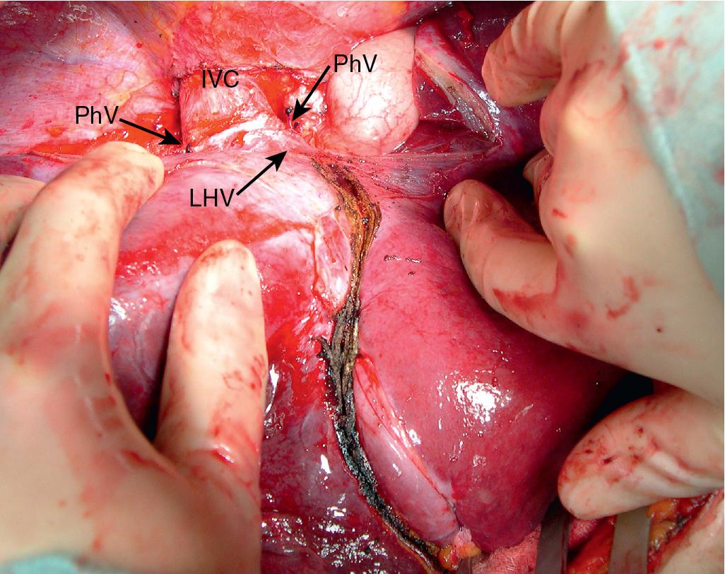 FIGURE 124.6, The phrenic veins (PhV) are divided, and the suprahepatic inferior vena cava (IVC) is dissected away from the diaphragm to allow adequate length for placement of a suprahepatic cava clamp. This allows for division of the suprahepatic vena cava with enough length to allow reanastomosis. LHV, Left hepatic vein.