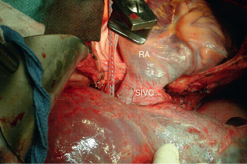 FIGURE 124.7, The addition of a median sternotomy provides excellent exposure to the suprahepatic inferior vena cava (SIVC) and confluence of the hepatic veins. RA, Right atrium.