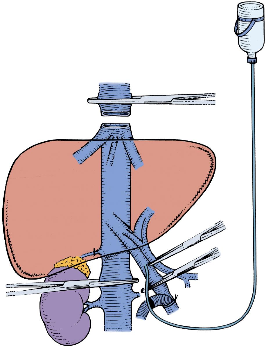 FIGURE 124.9, Veno-venous bypass can be used during ante situm perfusion. If more exposure is required to the retrohepatic inferior vena cava (IVC) than is provided by dividing the suprahepatic IVC alone, the infrahepatic IVC also can be divided, allowing the liver to be rotated completely up onto the abdominal wall.