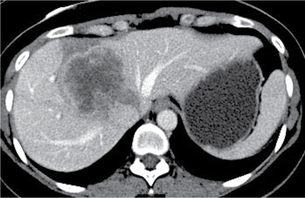 FIGURE 124.10, Computed tomographic scan showing a cholangiocarcinoma centered on all three hepatic veins at the junction of the inferior vena cava. Right portal structures were also involved. A right trisegmentectomy with reconstruction of the left hepatic vein was planned.