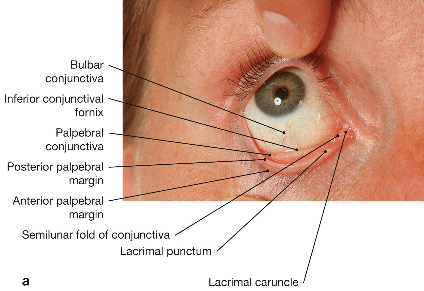 Fig. 9.2a and b, Eye, right side; upper and lower eyelids everted (a) ; with assisted ectropionized upper eyelid (b) .