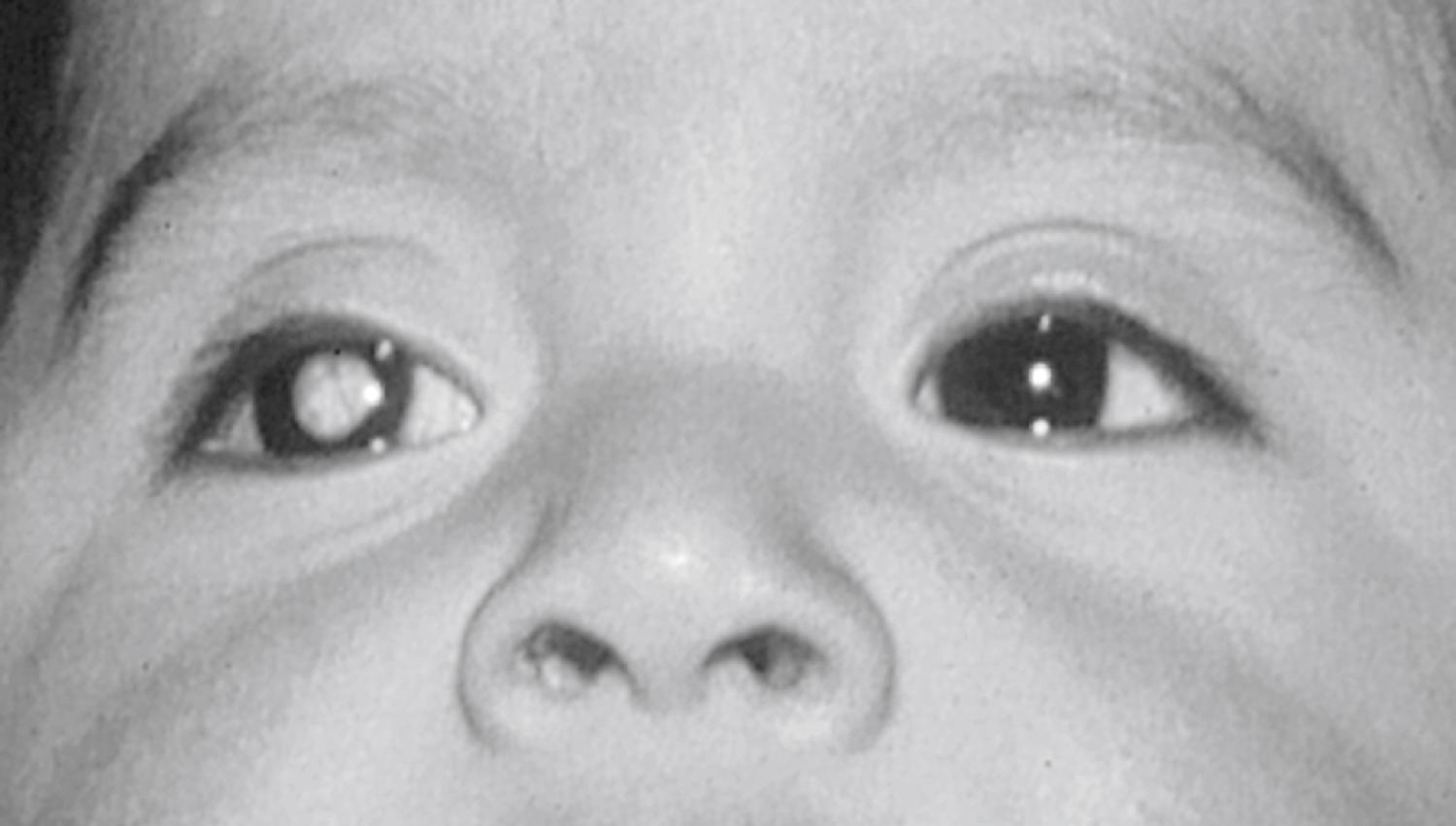 Fig. 43.11, Infant with leukocoria of right eye caused by retinoblastoma.