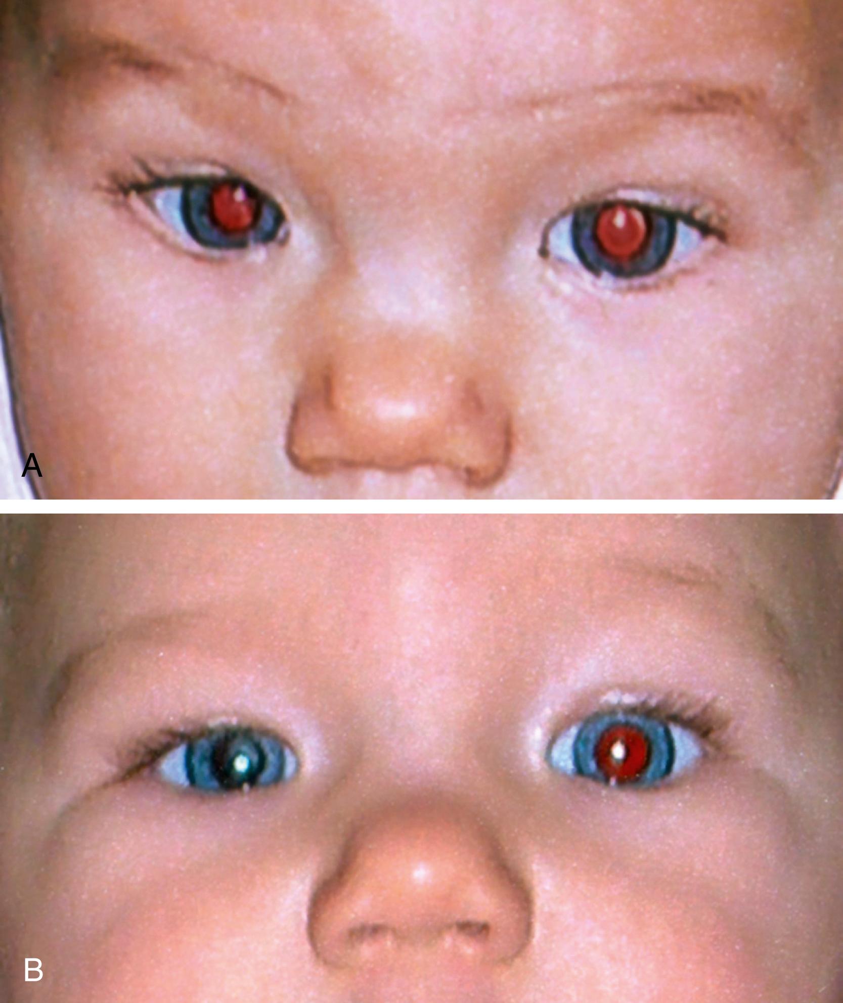 Fig. 43.12, A, Photograph of an infant taken when 4 months of age showing normal red reflexes in both eyes. B, Photograph of the same infant 2 months later showing loss of the red reflex in the right eye. At the time of cataract surgery, the right eye was found to have a dense central cataract and persistent fetal vasculature.