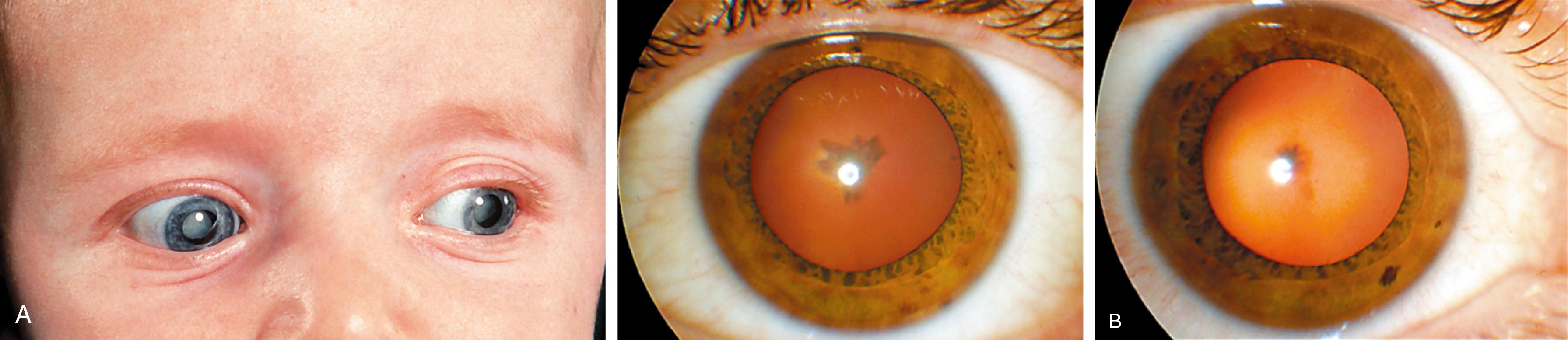 Fig. 43.13, Autosomal dominant cataracts. A, A 3-month-old infant with bilateral dense cataracts. B, His mother has mild cataracts.