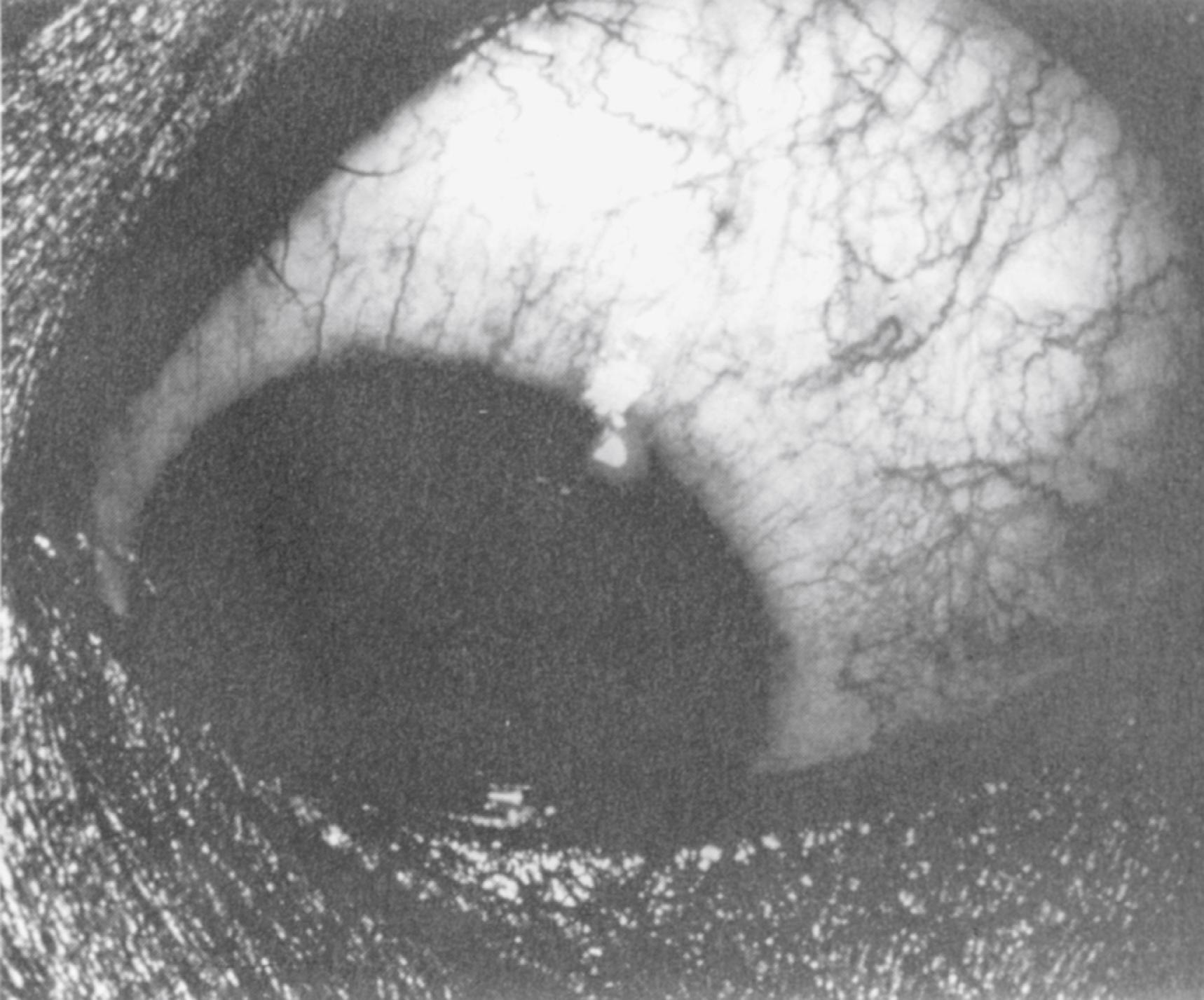 Fig. 43.15, Ciliary flush associated with iritis. Note the straight, radially oriented vessels extending out from the iris.