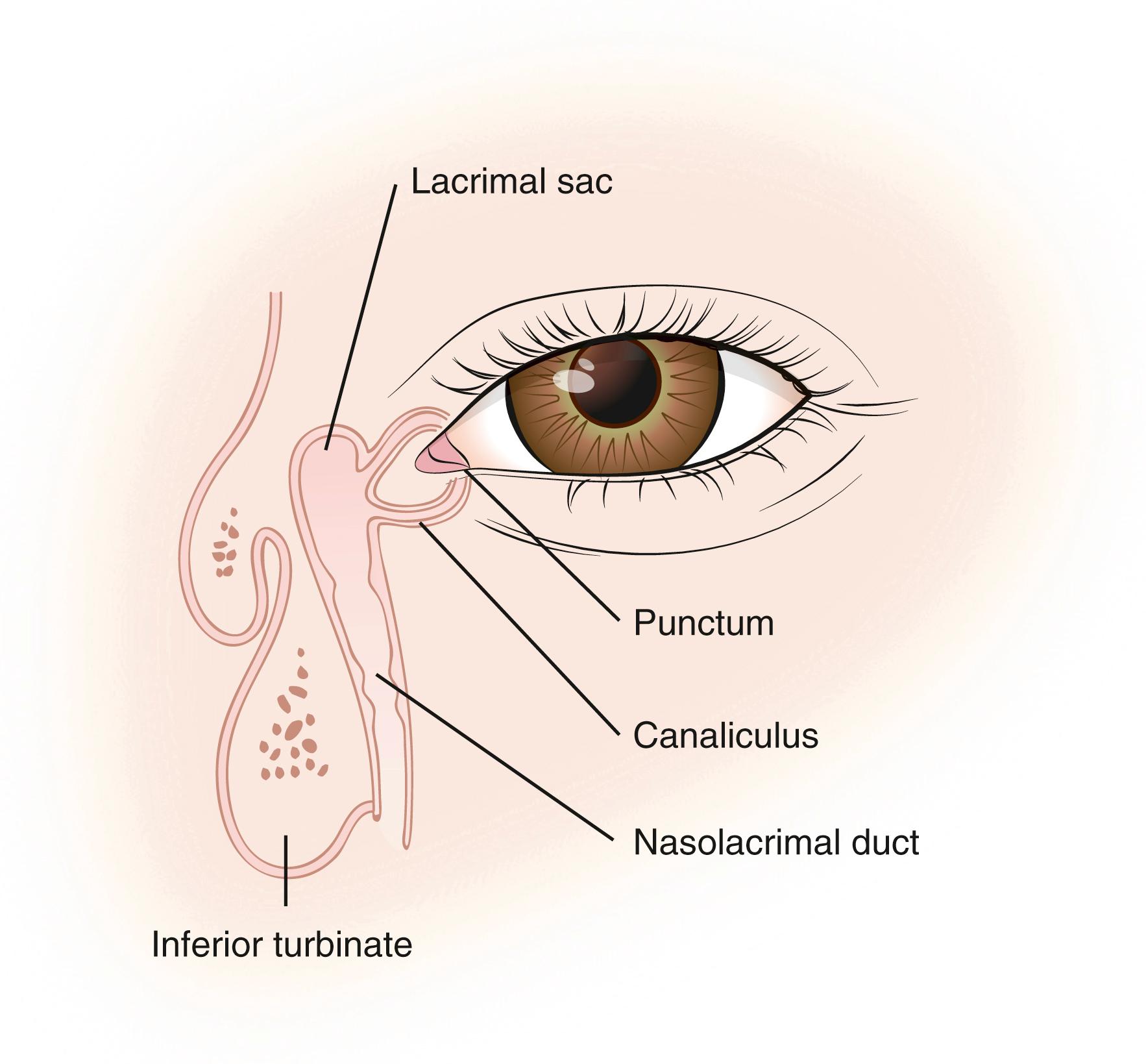 Fig. 43.17, Anatomy of the nasolacrimal drainage system.