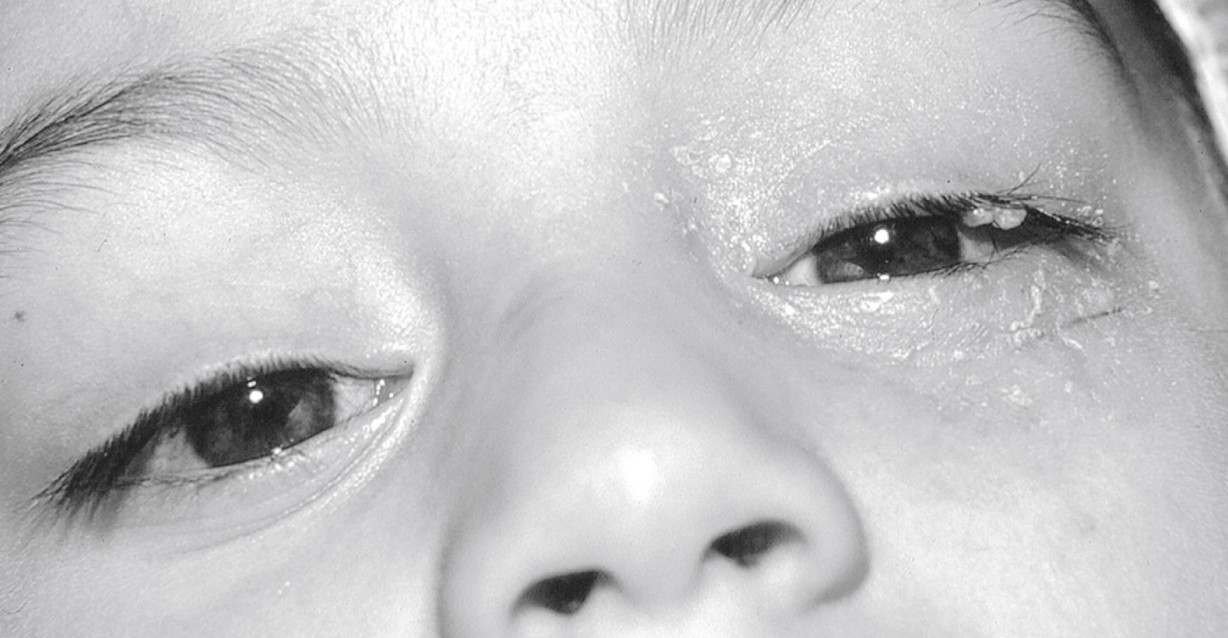 Fig. 43.19, Chronic eczematoid and follicular conjunctivitis in only the left eye, caused by Molluscum contagiosum, in a 5-year-old. Note the elevated lesions on the lateral aspect of the left upper eyelid.