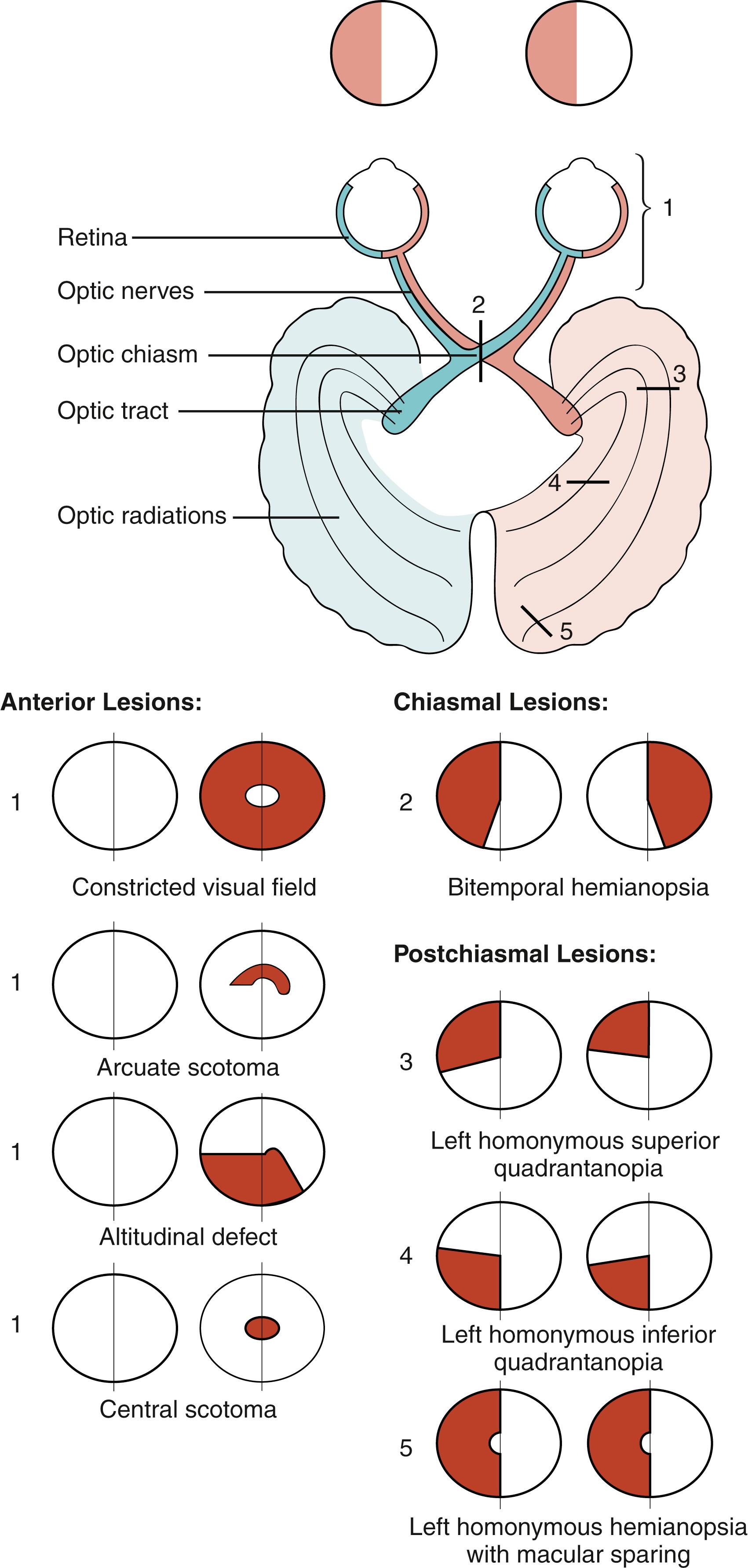 Fig. 43.2, Anatomy of the visual pathways. The anatomy of the visual pathways appears at the top of the figure, the pink shading indicating how visual information from the left visual space eventually courses to the right brain. Visual field defects are at the bottom of the figure. Anterior defects (labeled 1 from disease of the optic nerve or retina) characteristically affect one eye and cause defects (red shading) that may cross the vertical meridian (i.e., the vertical meridian is the vertical line bisecting each visual field). Chiasmal defects (labeled 2 ) and postchiasmal defects (labeled 3 for a lesion in the anterior temporal lobe, 4 for the parietal lobe, and 5 for the occipital cortex) characteristically affect both eyes and respect the vertical meridian.