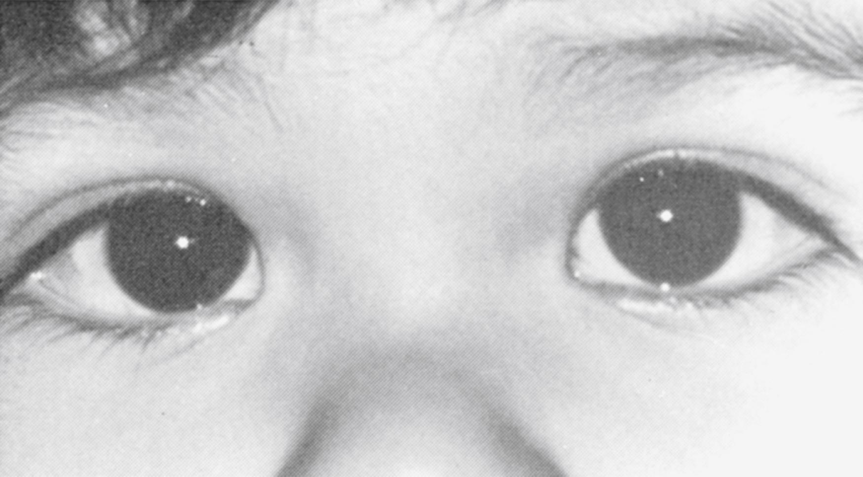 Fig. 43.5, A child with pseudoesotropia. Note that the wide nasal bridge and prominent epicanthal folds create the illusion of an esotropia. The corneal light reflexes are centered in each eye; therefore, the eyes are straight.