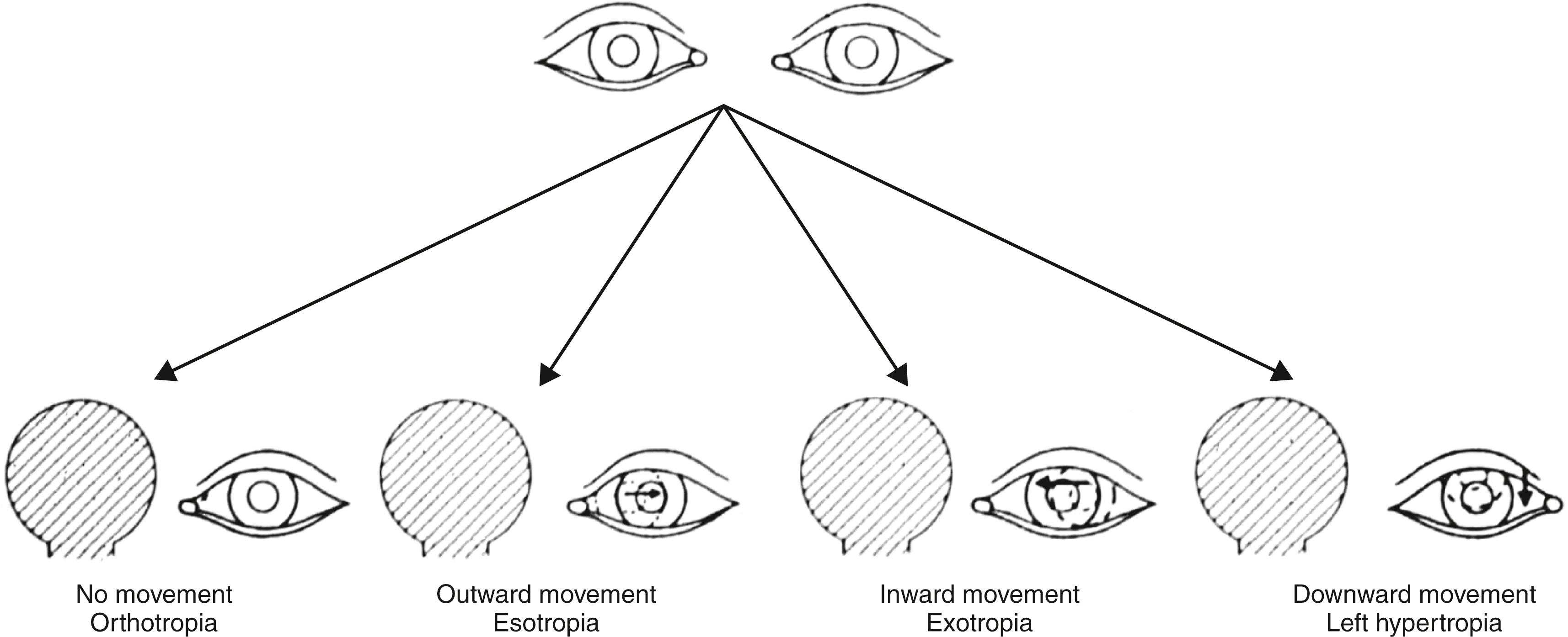 Fig. 43.6, The cover test. In each instance, the occluder is placed over the right eye while the patient is viewing a fixation target and the examiner is watching for movement of the patient’s left eye. If the left eye is not aligned, it will need to move to look at the fixation target. If there is no movement of the left eye, the test needs to be repeated by occluding the left eye and watching for movement of the right eye.