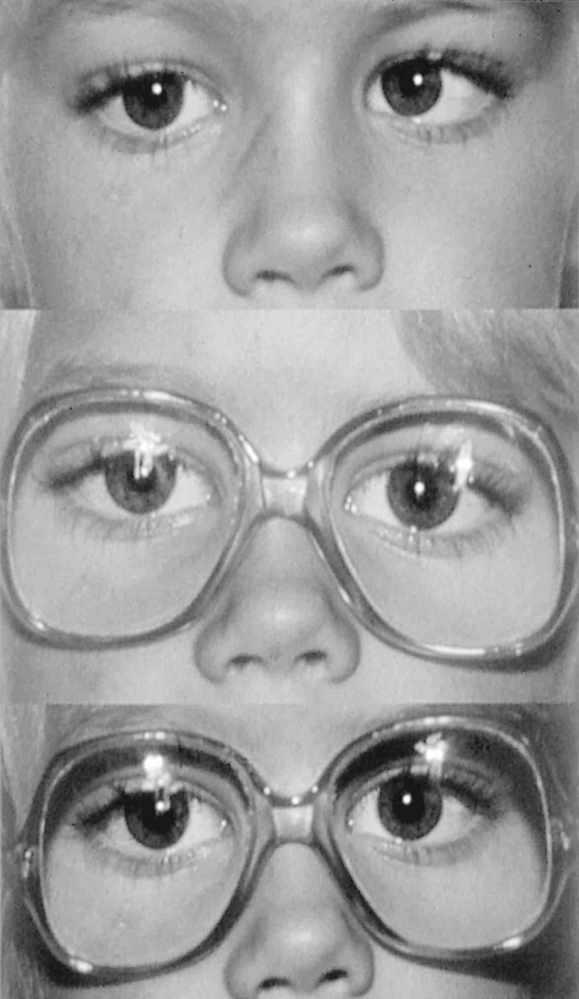 Fig. 43.7, Accommodative esotropia (top). The deviation is completely controlled with glasses at both distant (middle) and near (bottom) fixation distances.