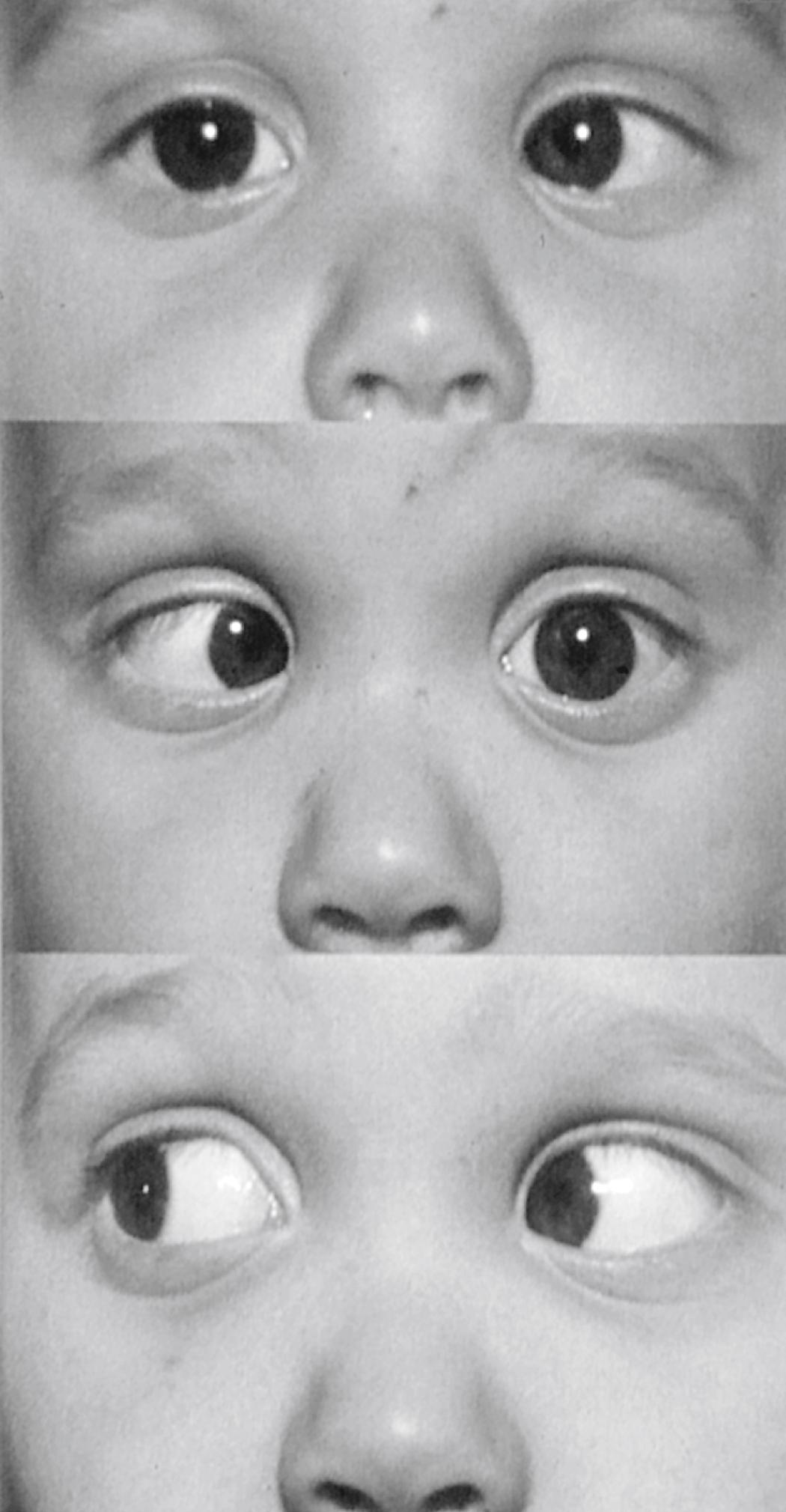 Fig. 43.8, Left sixth cranial nerve palsy in a 4-year-old. A large manifest esotropia is present when the child looks straight ahead (top). The left eye does not abduct beyond the midline in gaze to the left (middle). Gaze to the right is normal (bottom).